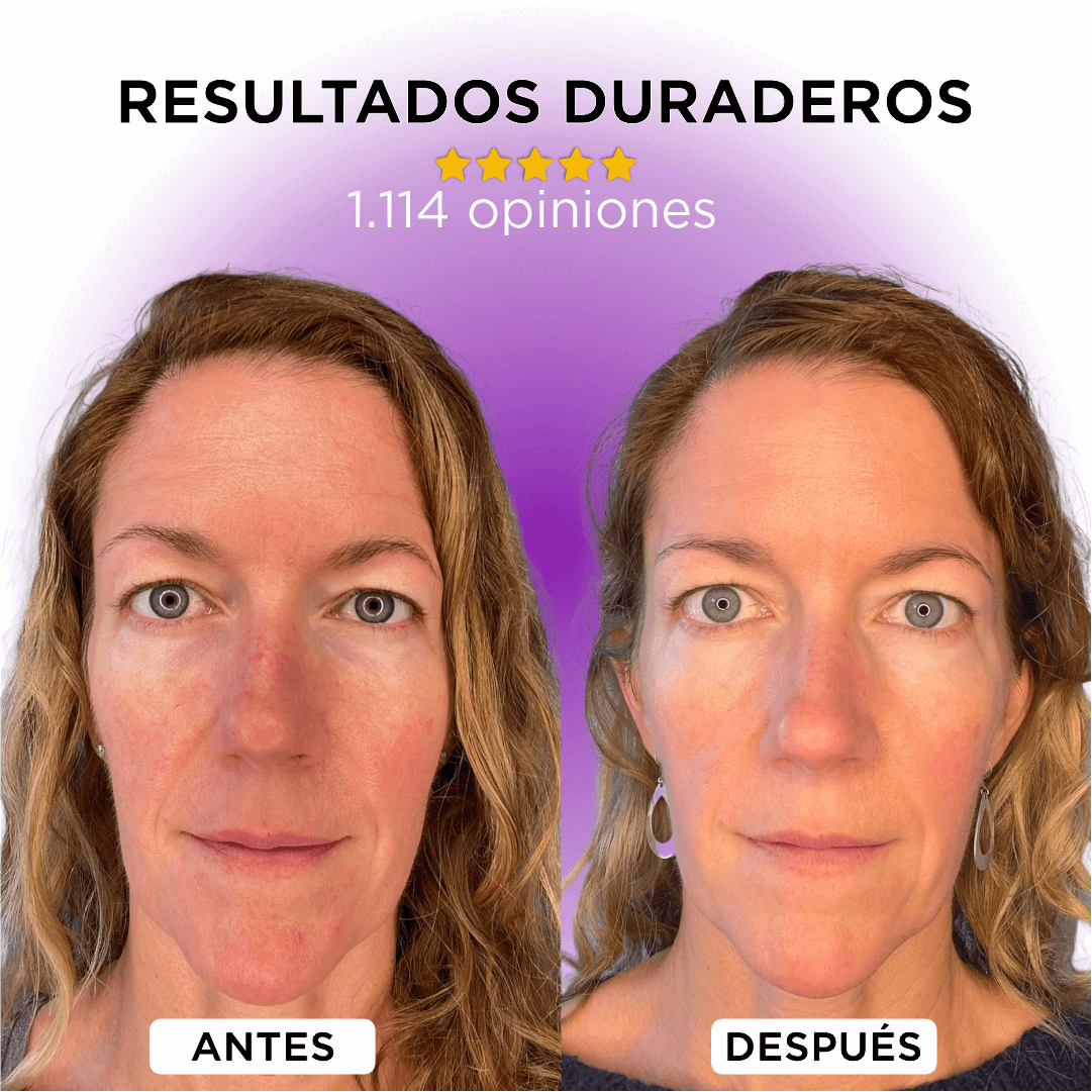 Dermawand Pro: Rejuvenece tu piel en 10 minutos, sin tratamientos invasivos y sin dolor + Retinol antienvejecimiento GRATIS