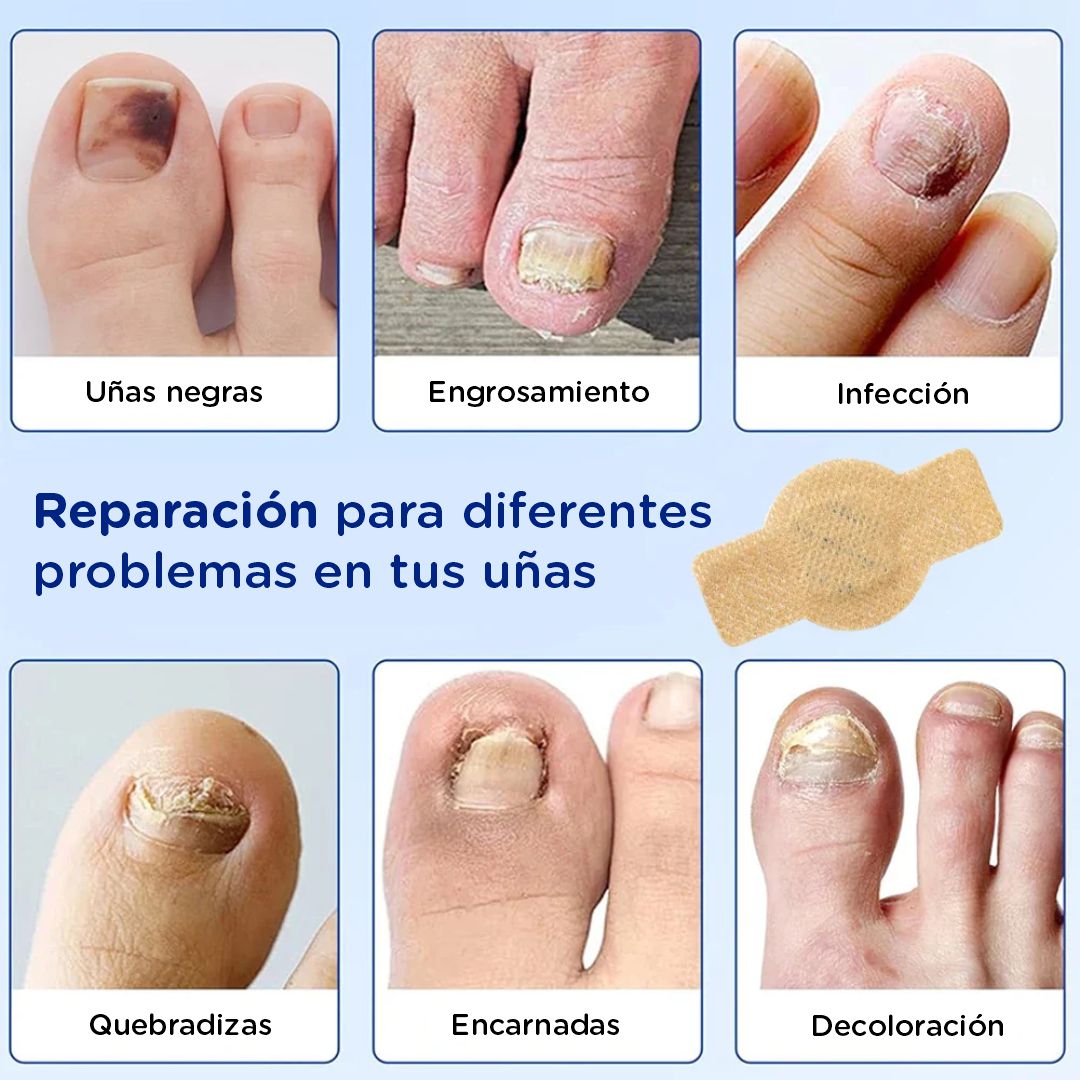 FungalNail Patches: Combate los hongos y repara tus uñas mientras duermes