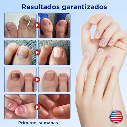 FungalNail Patches: Combate los hongos y repara tus uñas mientras duermes